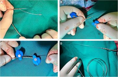 Case Report: Extraction of a stylet-driven lead for left bundle branch area pacing >2 years after implantation